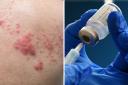 Are you eligible for the shingles jab?